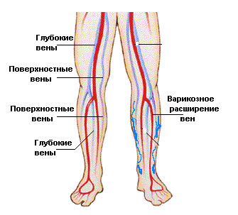 Варикозное расширение вен (кровоток)